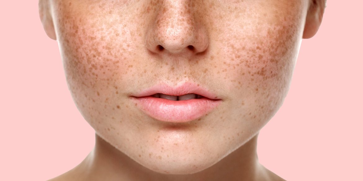 як вивести пігментні плями з обличчя в домашніх умовах