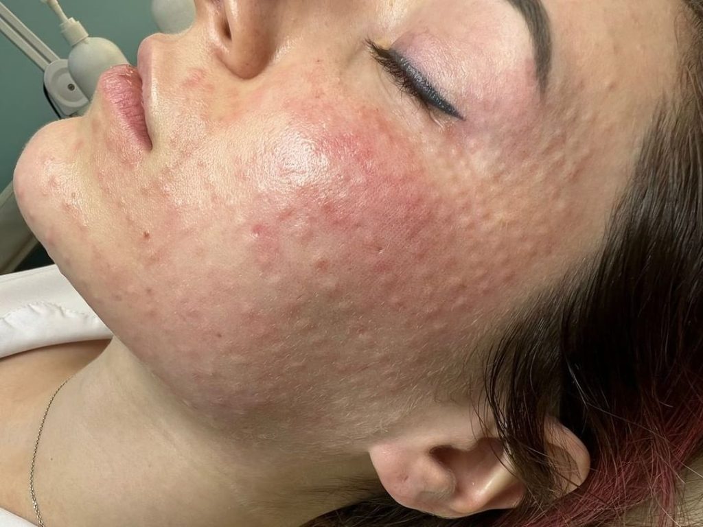 Види мезотерапії