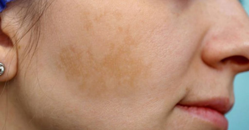 Чи можна прибрати пігментні плями в домашніх умовах